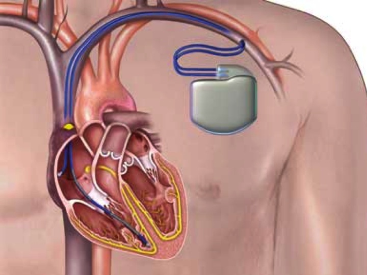 Implantable Cardioverter Defibrillator (ICD) Dr Matthew